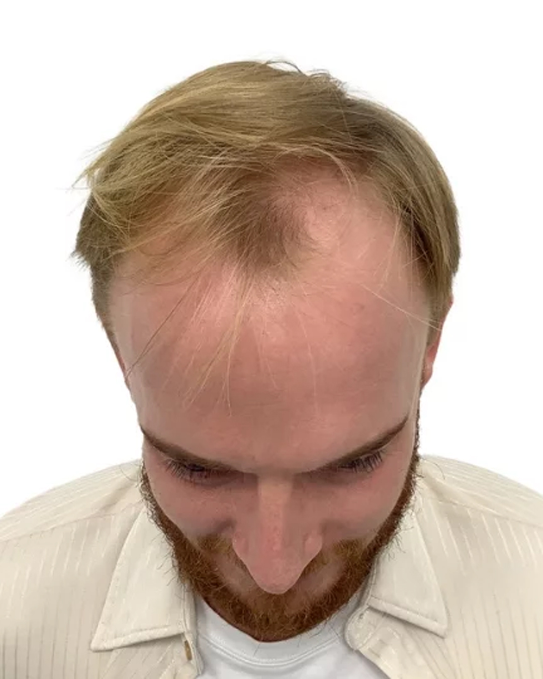 Simon før hårtransplantationen