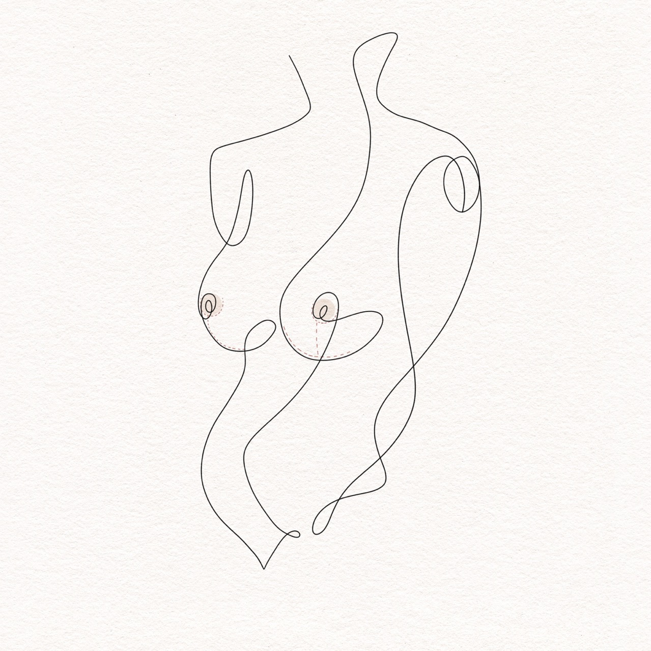 Breast Reduction