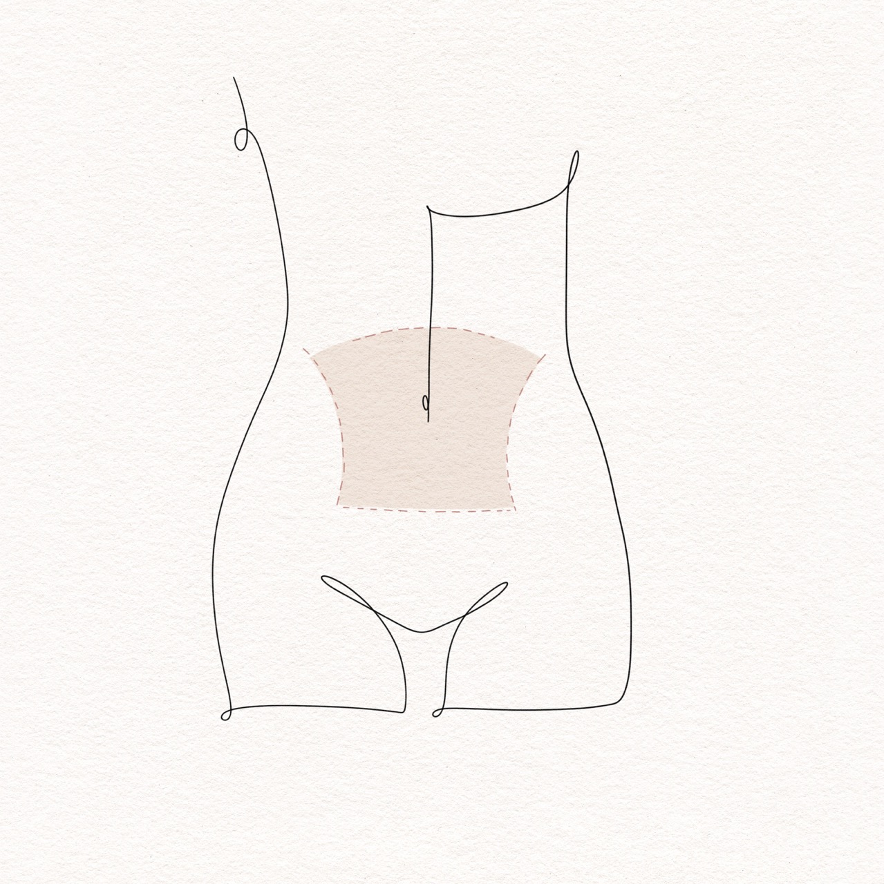 Tummy Tuck
