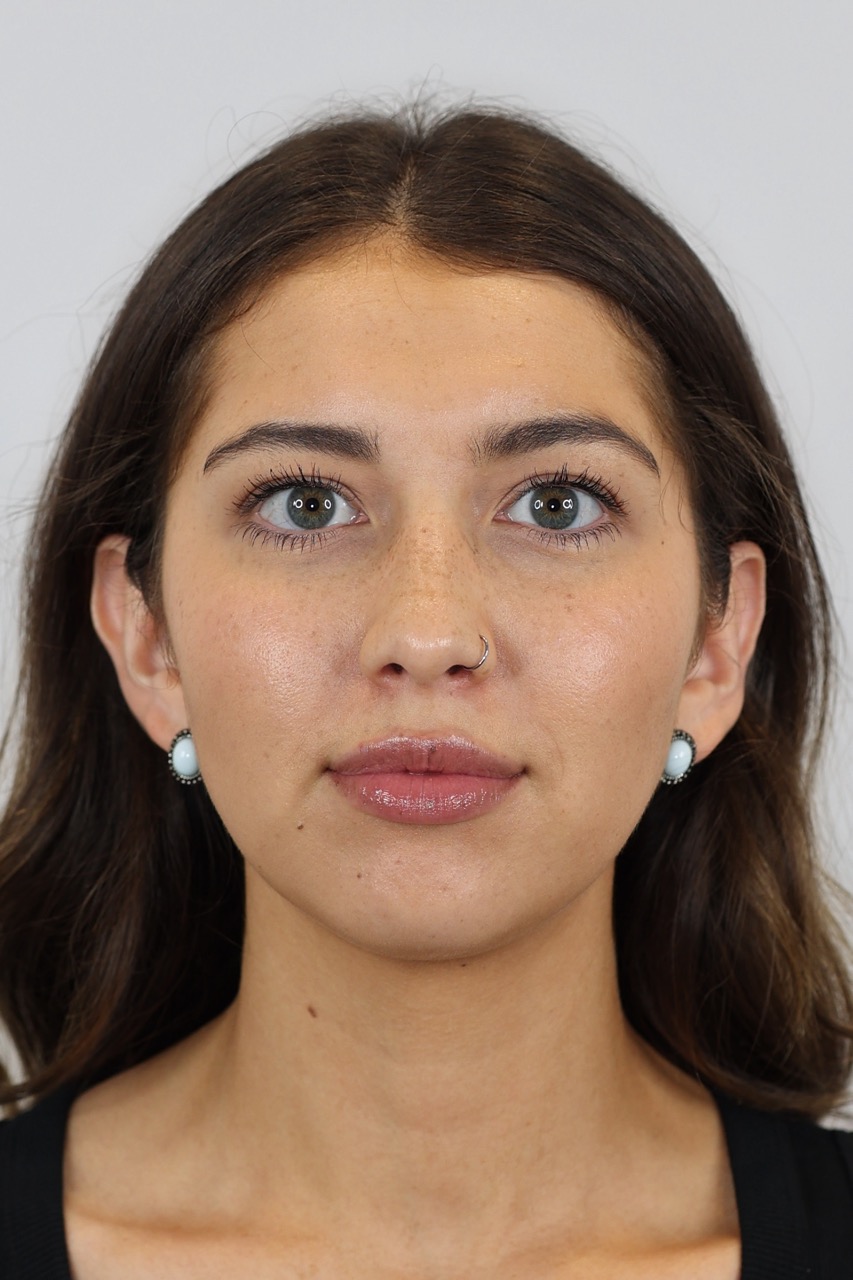 Lip & Chin Filler