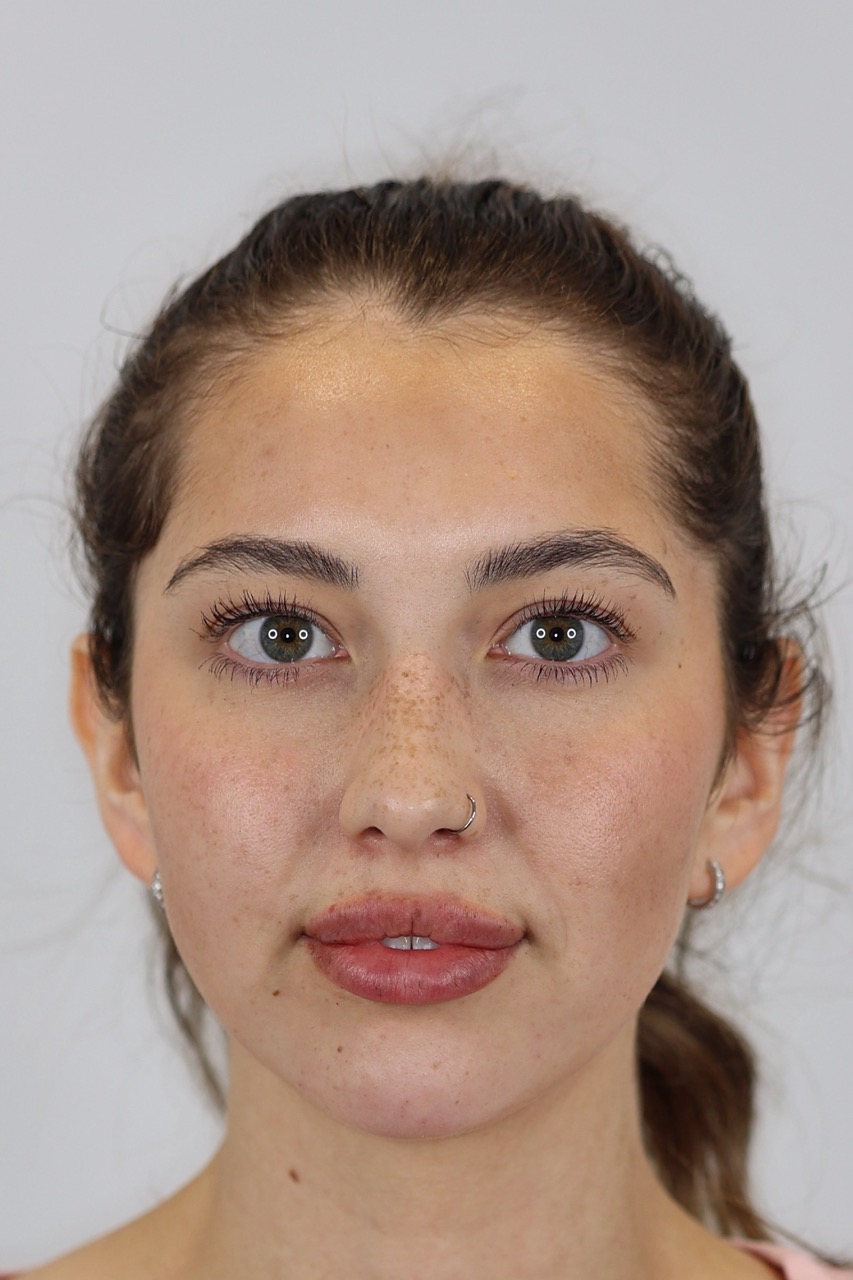 Lip & Chin Filler