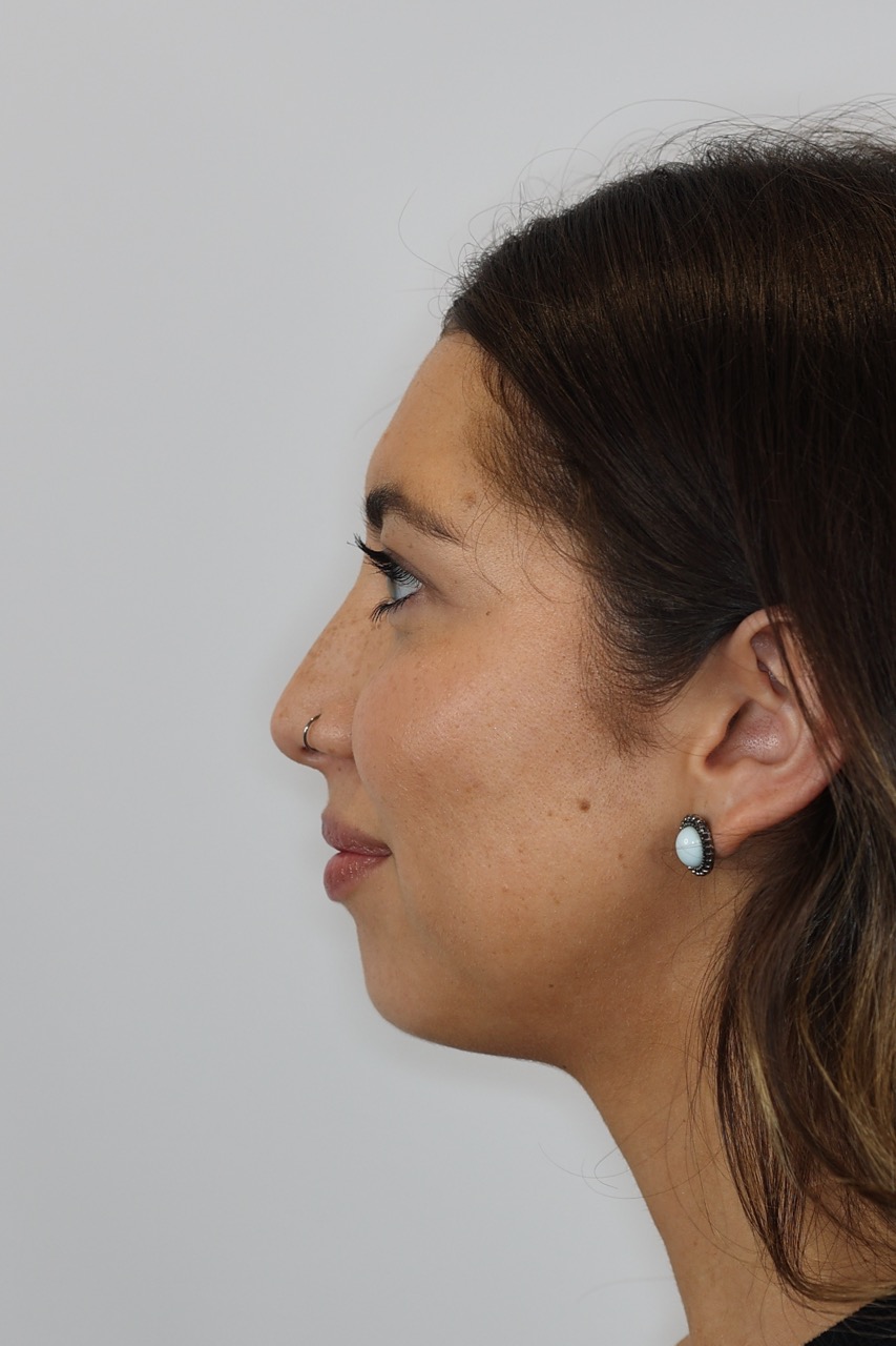 Lip & Chin Filler