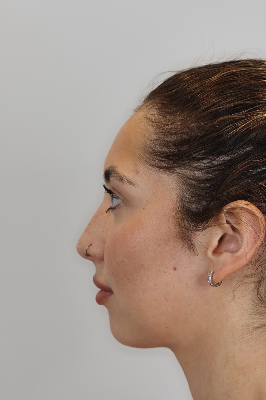 Lip & Chin Filler