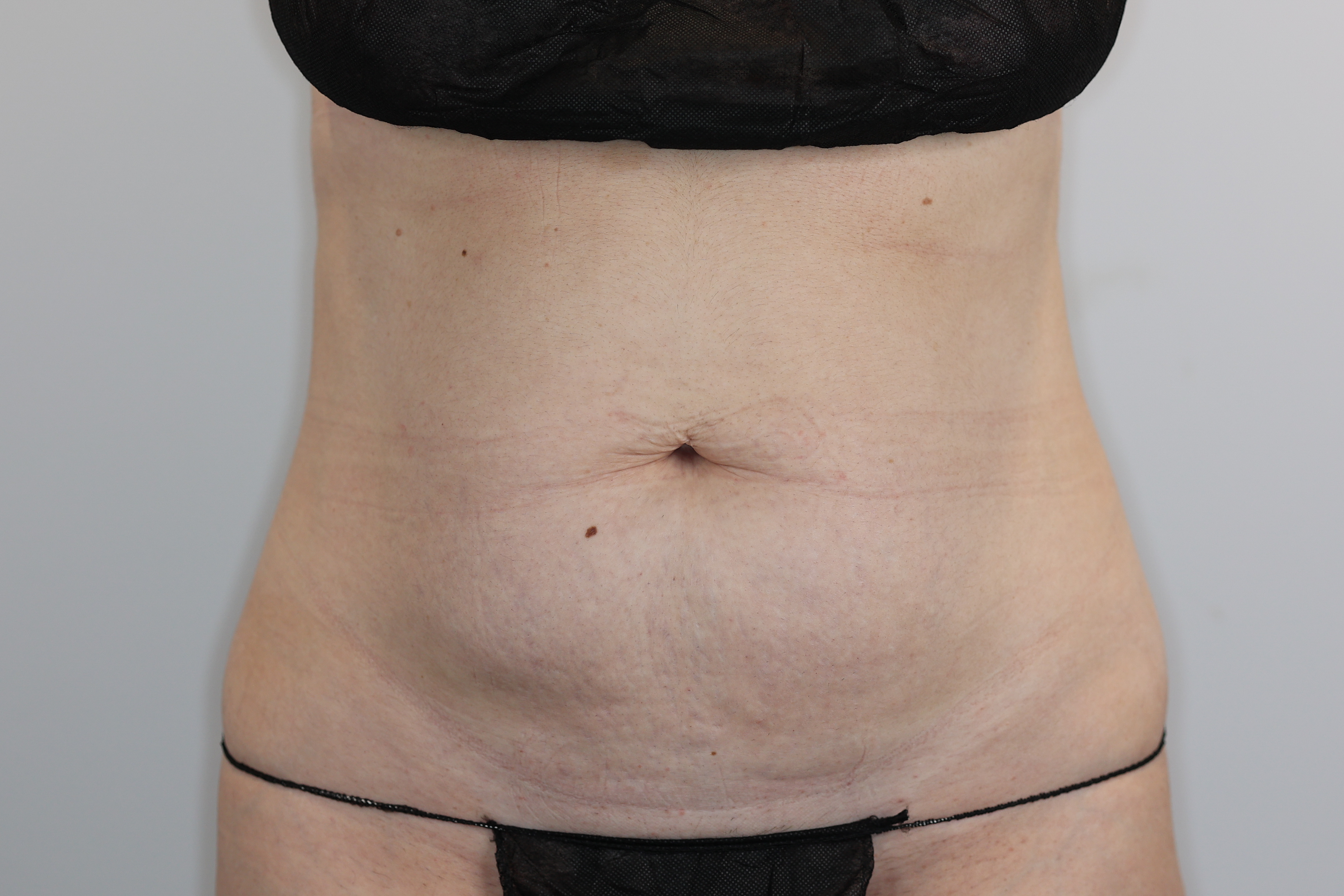 Tummy Tuck