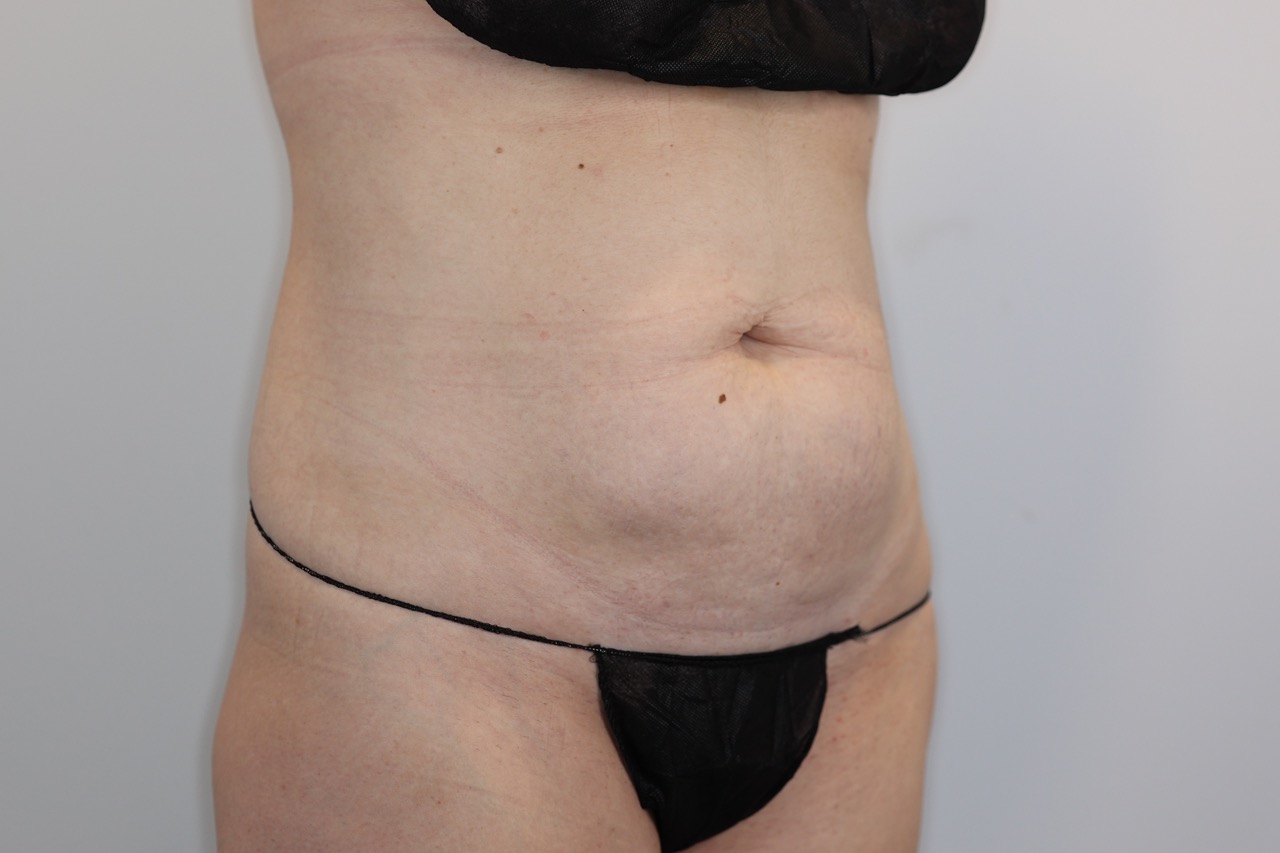 Tummy Tuck