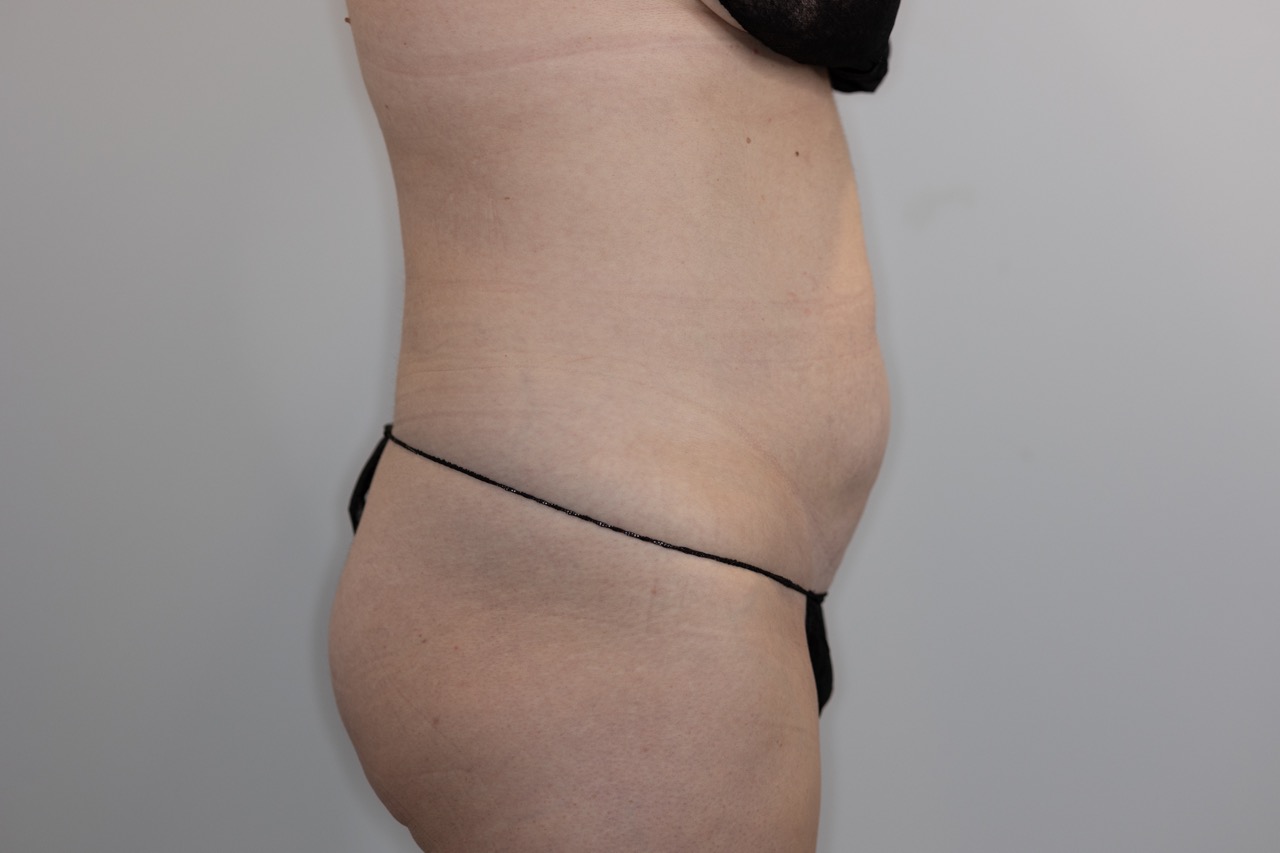Tummy Tuck