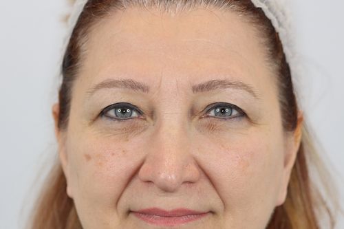 Eyelid Surgery (Upper Blepharoplasty)