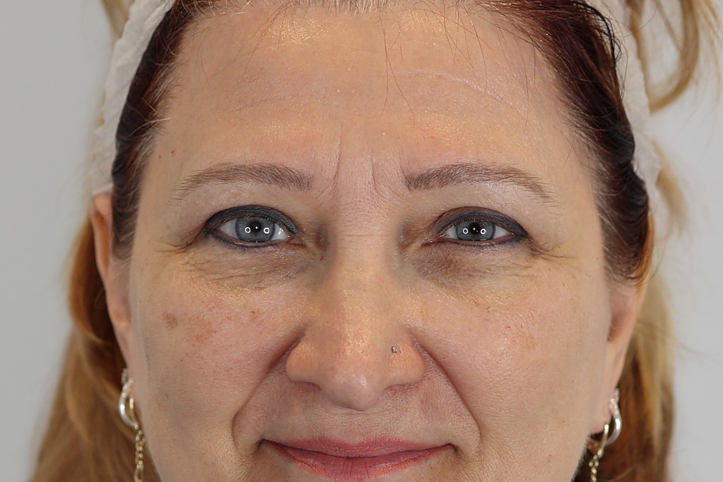 Eyelid Surgery (Upper Blepharoplasty)