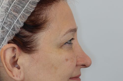 Eyelid Surgery (Upper Blepharoplasty)
