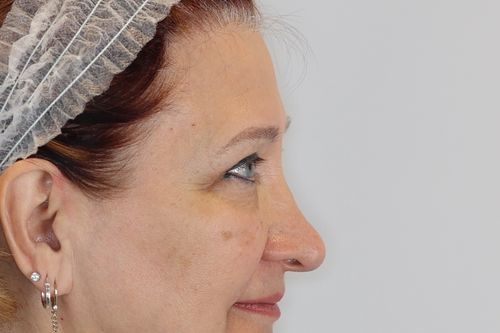 Eyelid Surgery (Upper Blepharoplasty)