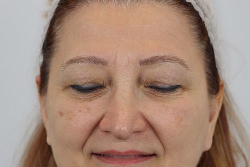 Eyelid Surgery (Upper Blepharoplasty)