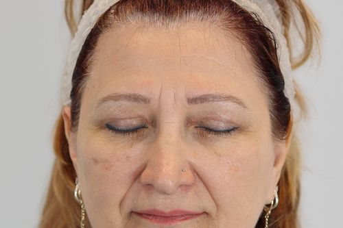 Eyelid Surgery (Upper Blepharoplasty)