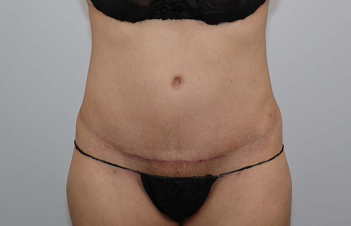 Tummy Tuck