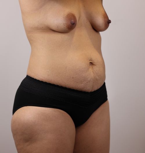 Tummy Tuck