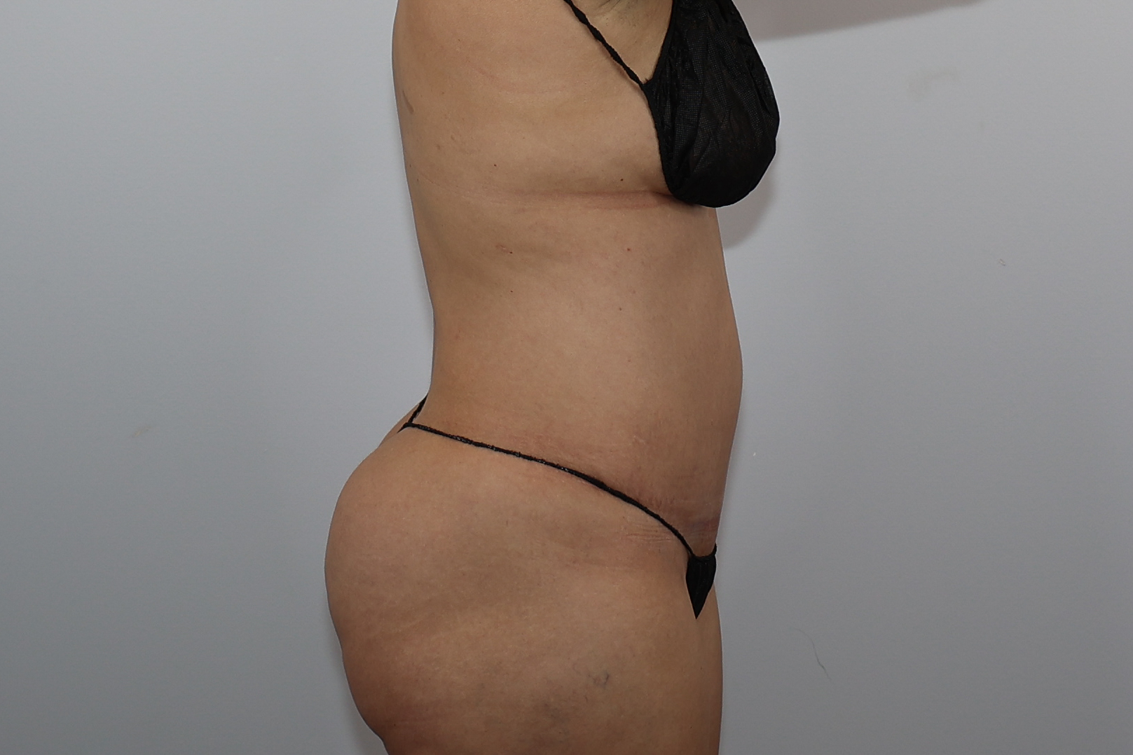 Tummy Tuck