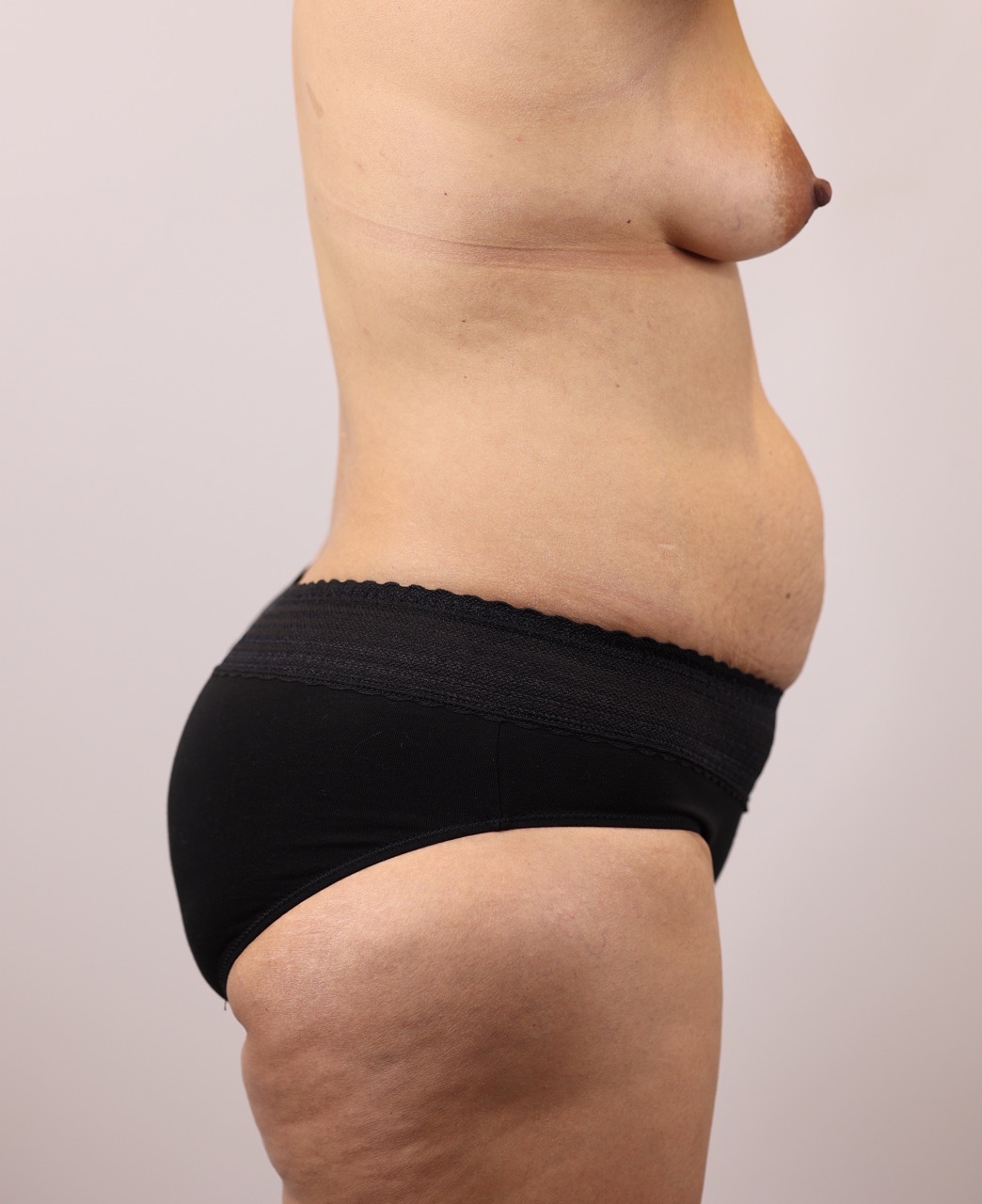 Tummy Tuck