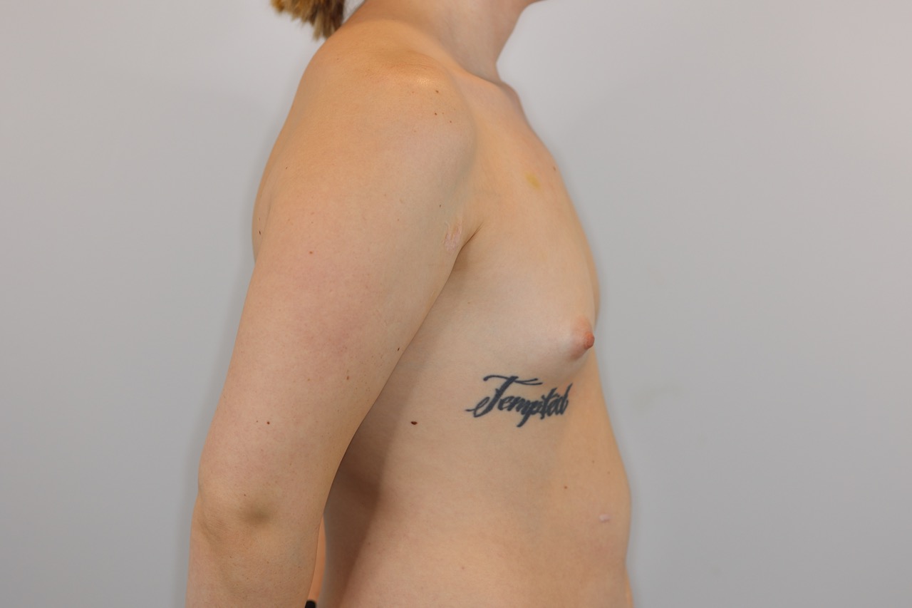 Fat Transfer to Breasts