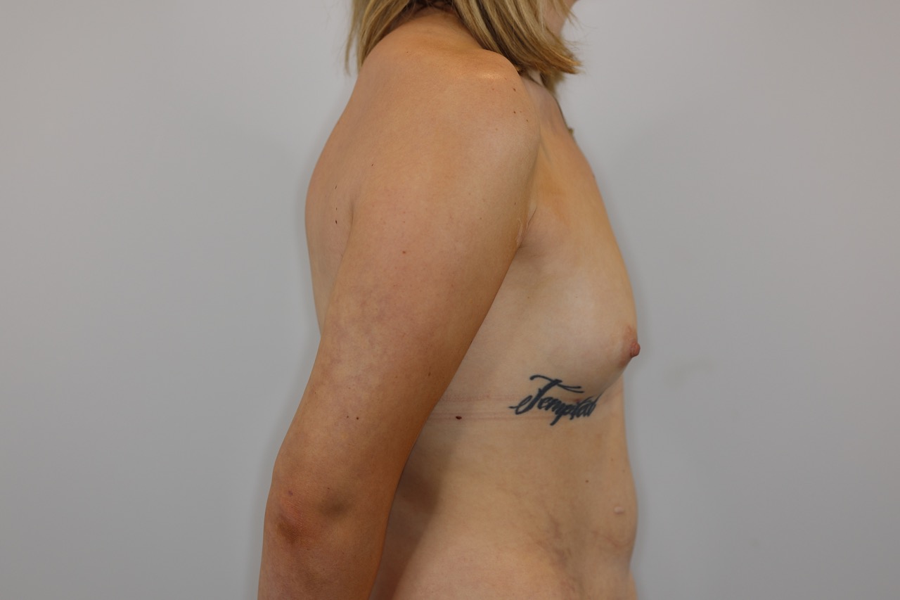 Fat Transfer to Breasts