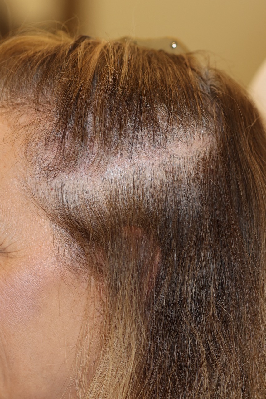 Hair Restoration