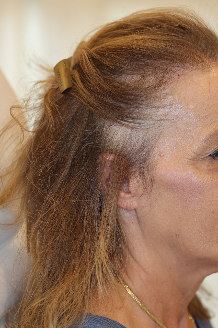 Hair Restoration