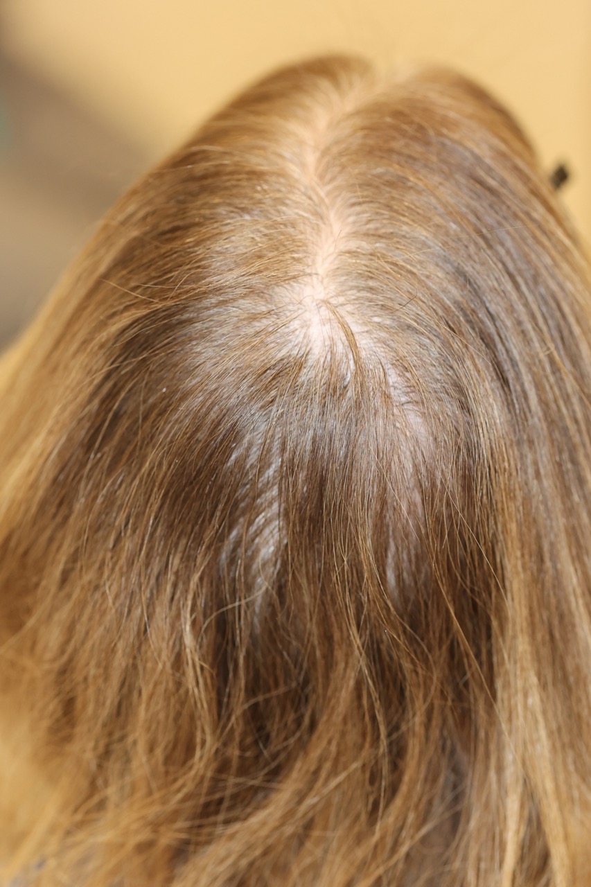 Hair Restoration