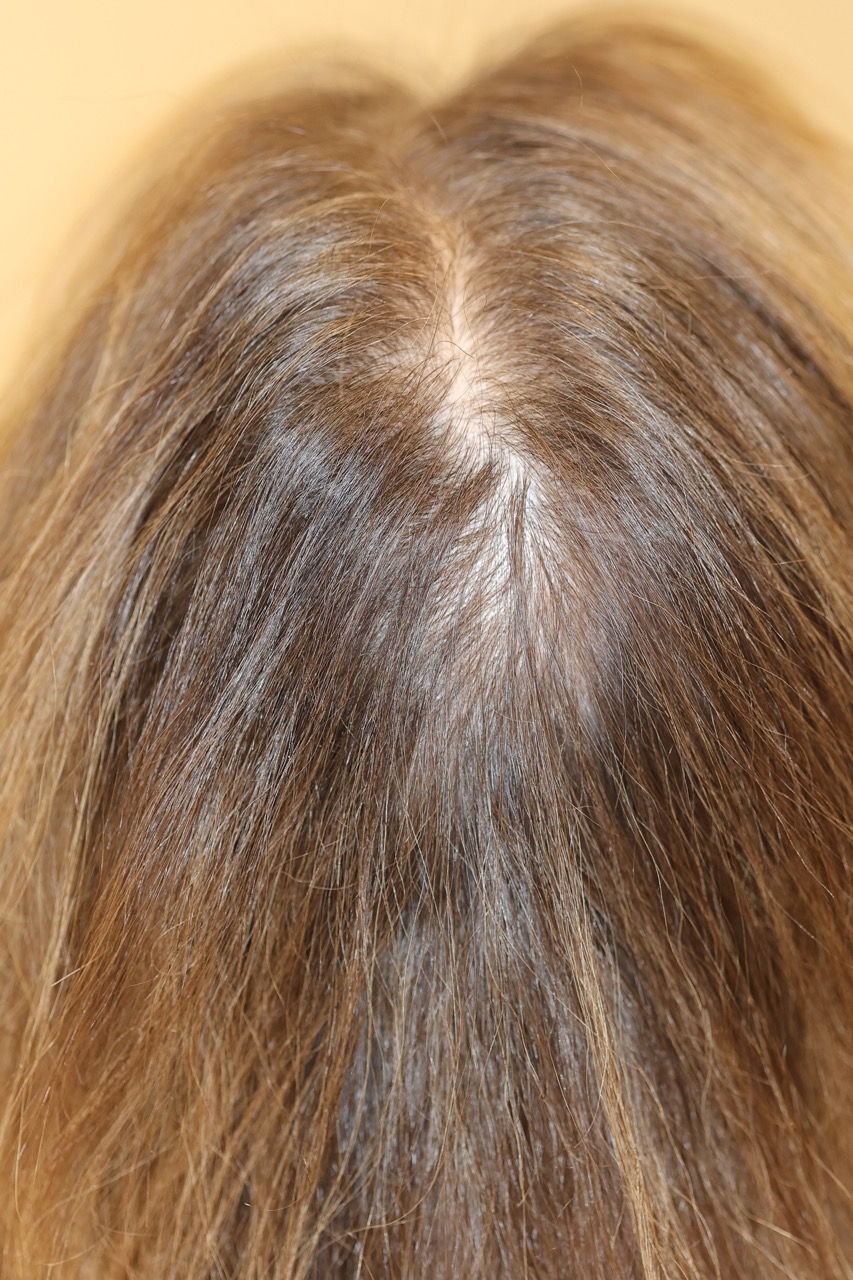 Hair Restoration