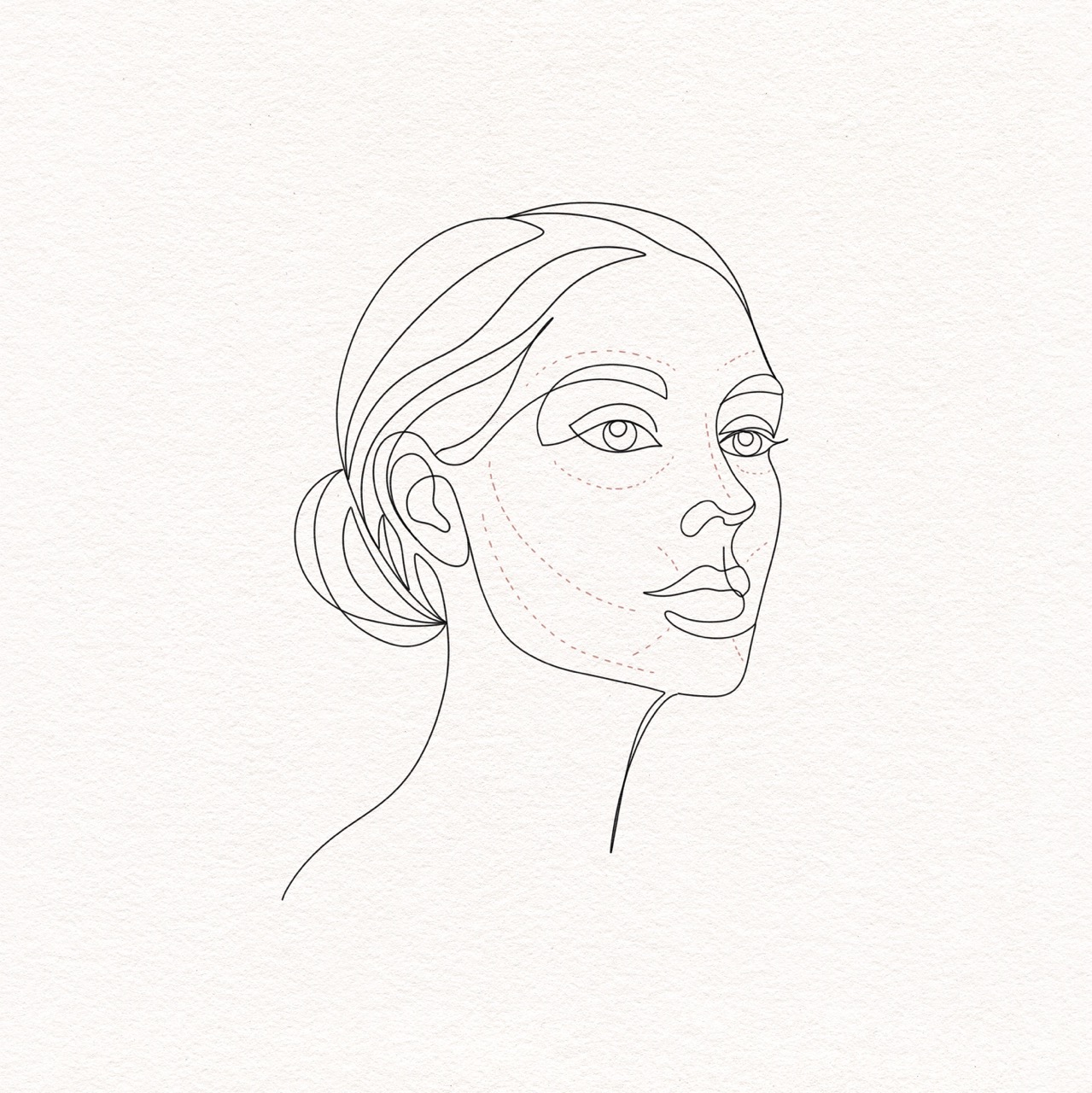 Neurotoxin (Botox & Dysport)