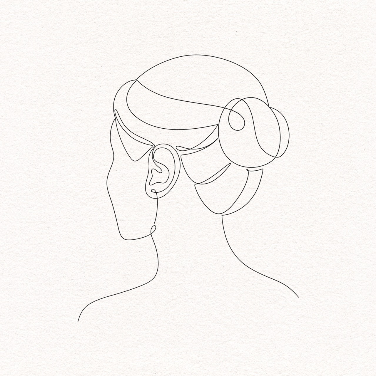 Otoplasty (Ear Pinning)