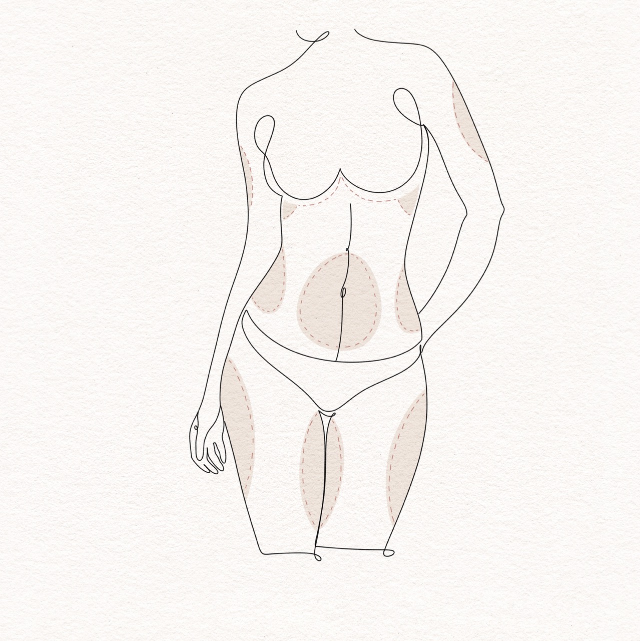 Liposuction