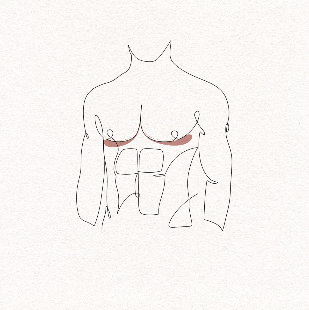 Gynecomastia