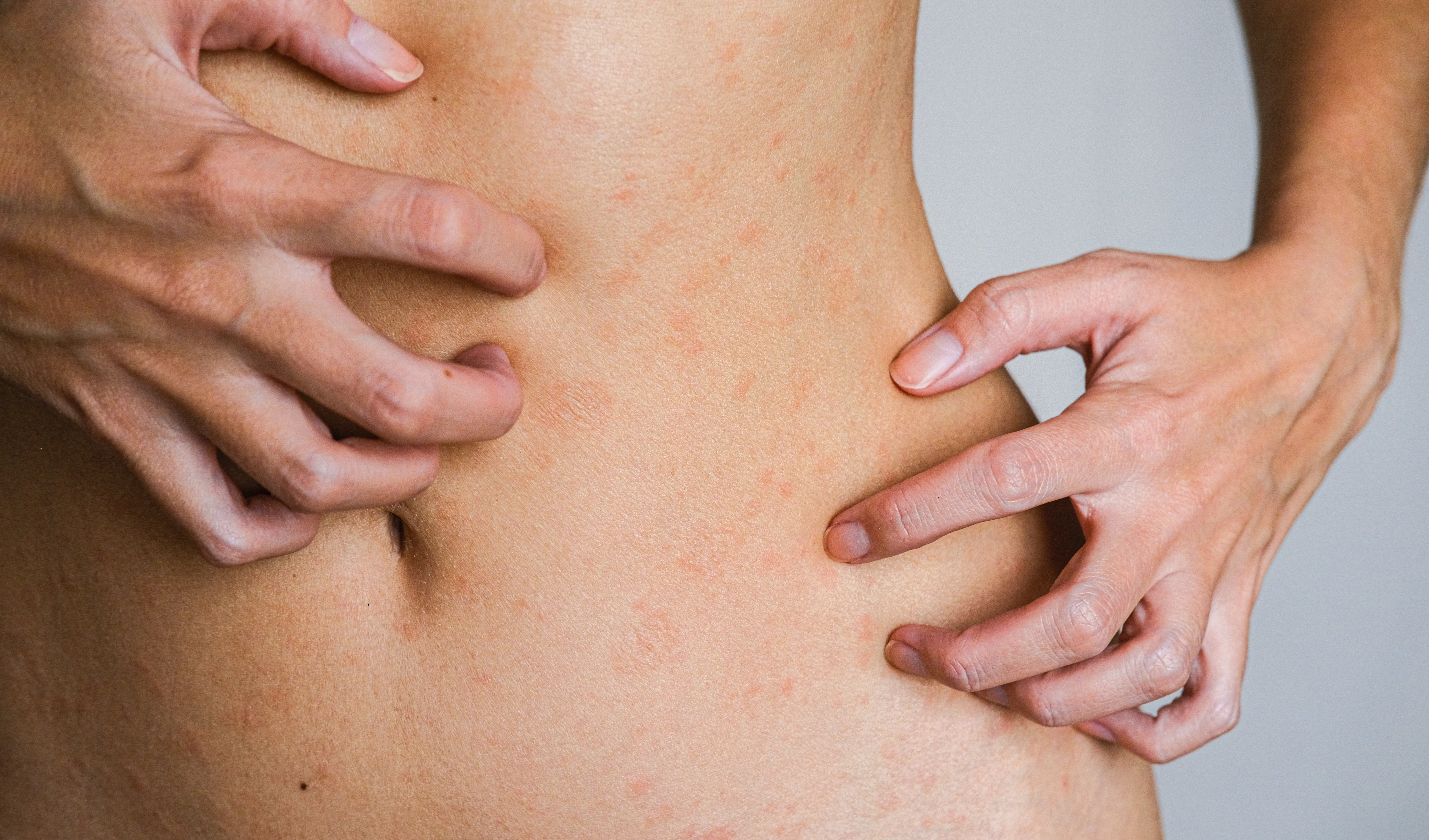 Why Am I Itchy After Plastic Surgery? Understanding Skin Flaking, Itchiness & What’s Normal During Recovery