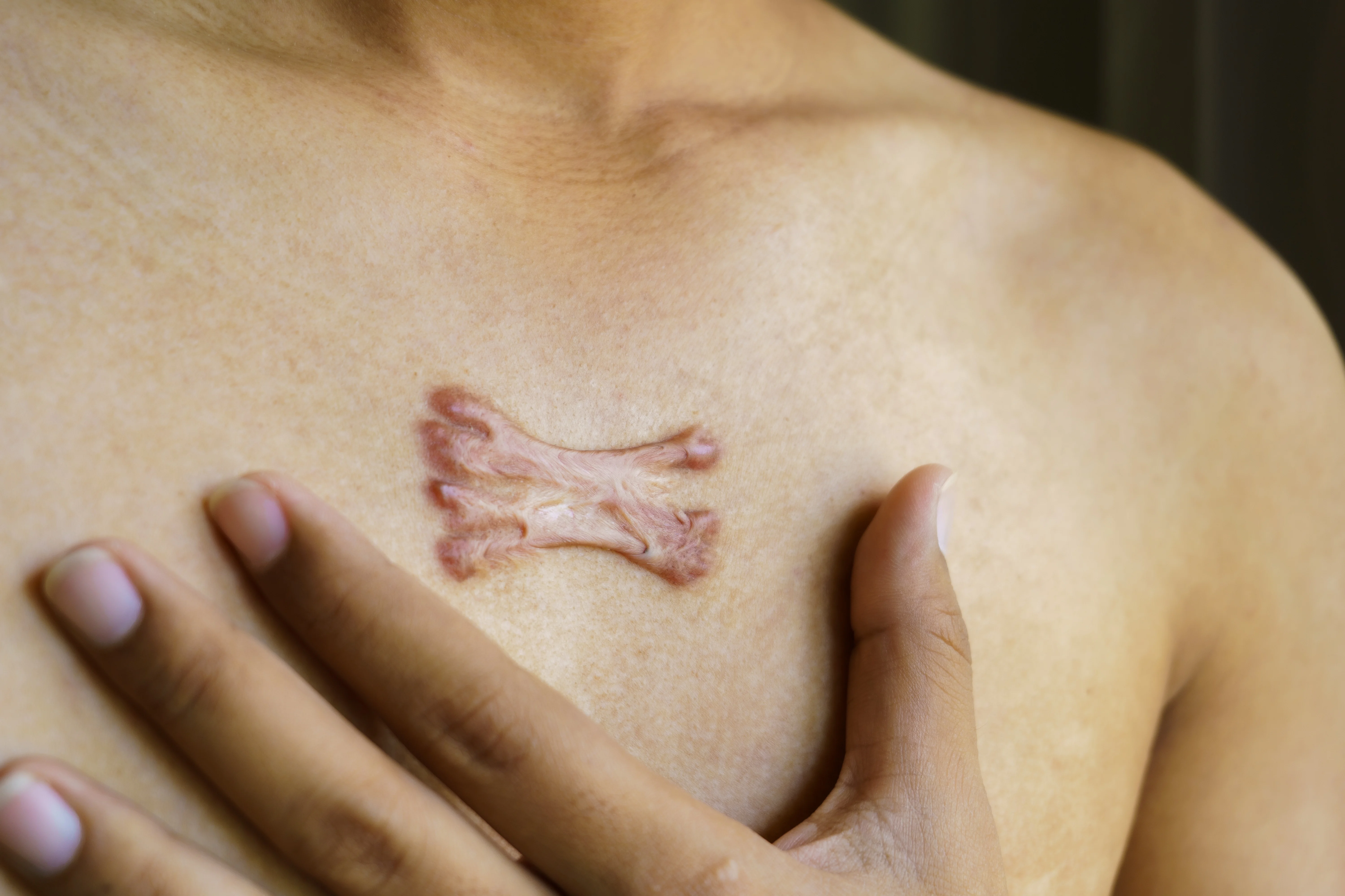 Hypertrophic vs. Keloid Scars: What’s the Difference and How to Prevent Them
