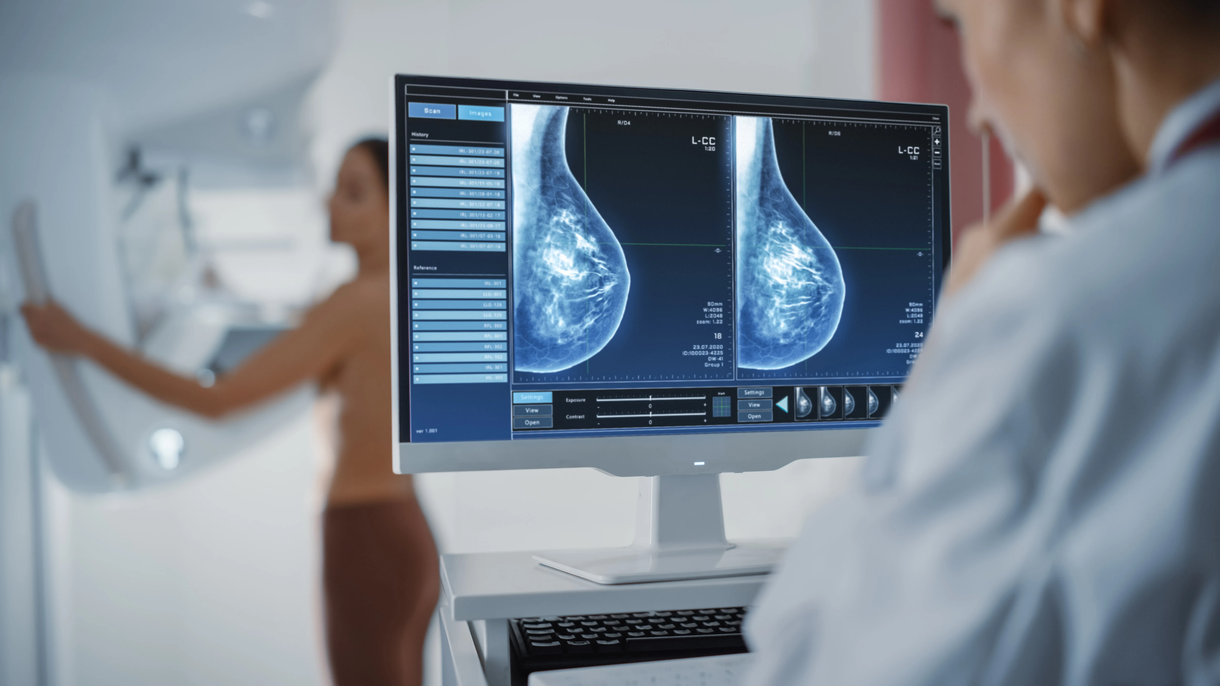 Do Fat Transfers to the Breasts Affect Mammograms?