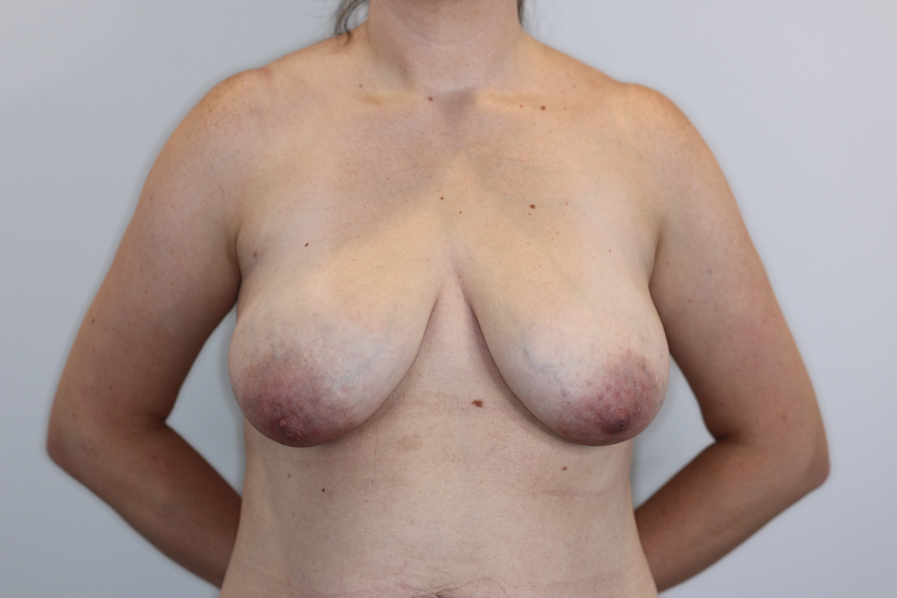 Breast Lift with Implants