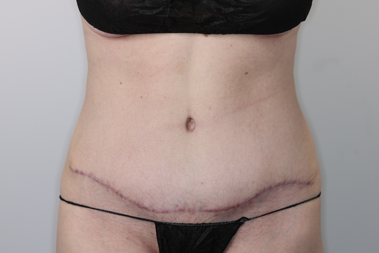 Tummy Tuck
