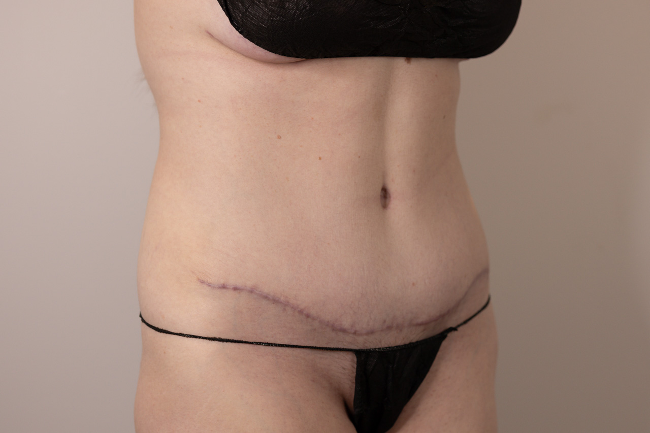 Tummy Tuck