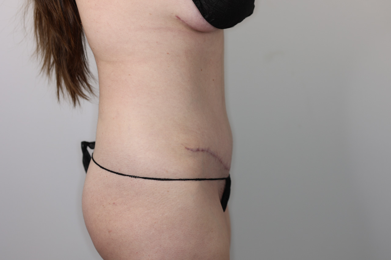Tummy Tuck