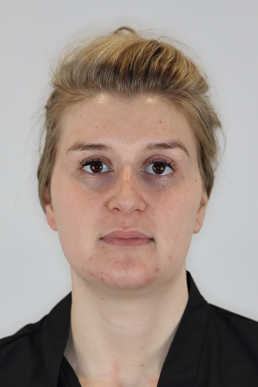 Neck (Chin) Liposuction