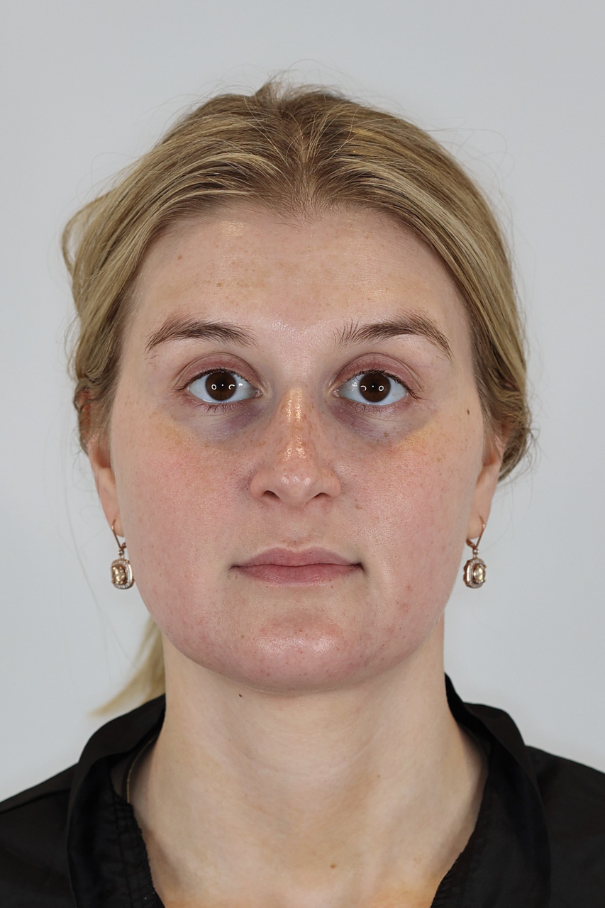 Neck (Chin) Liposuction