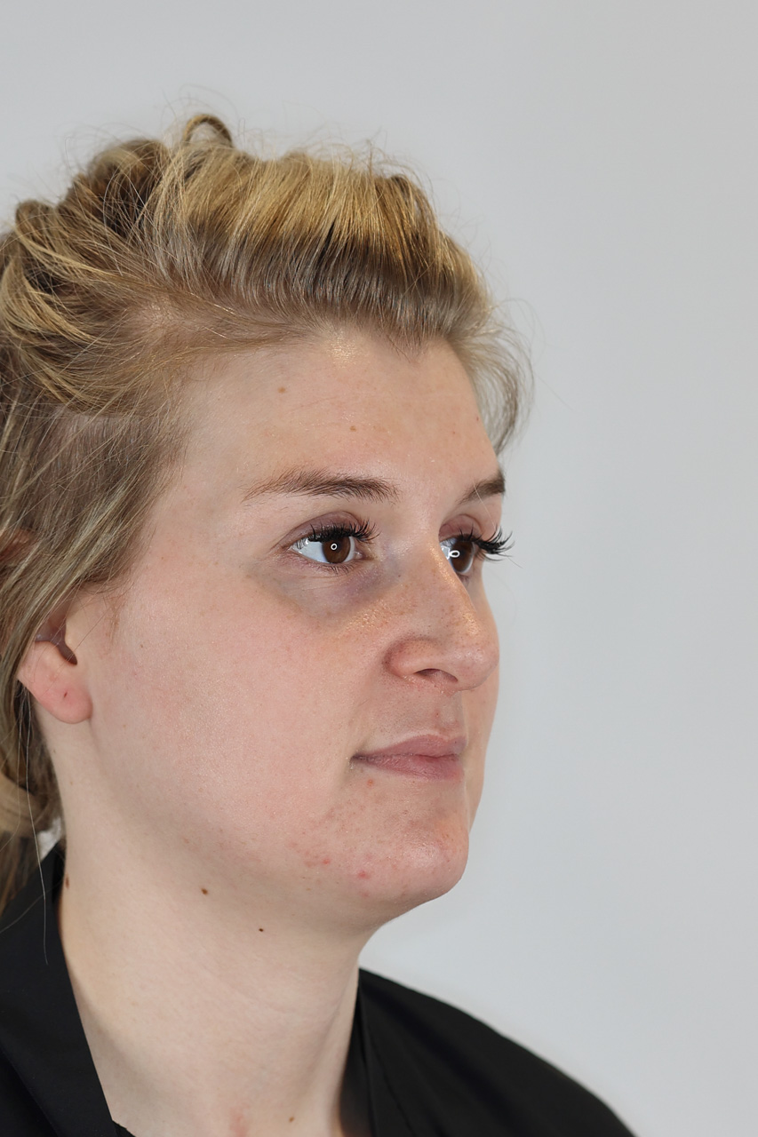 Neck (Chin) Liposuction
