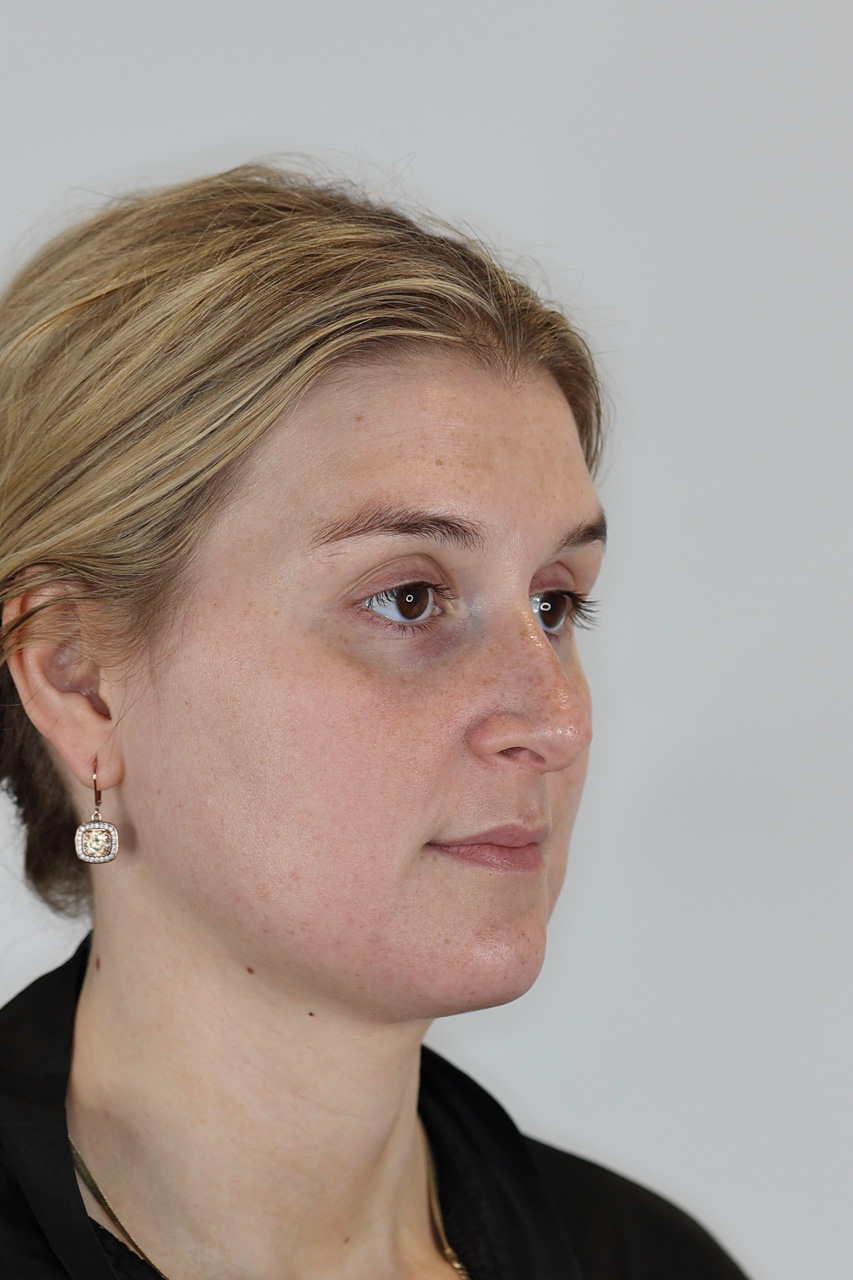 Neck (Chin) Liposuction