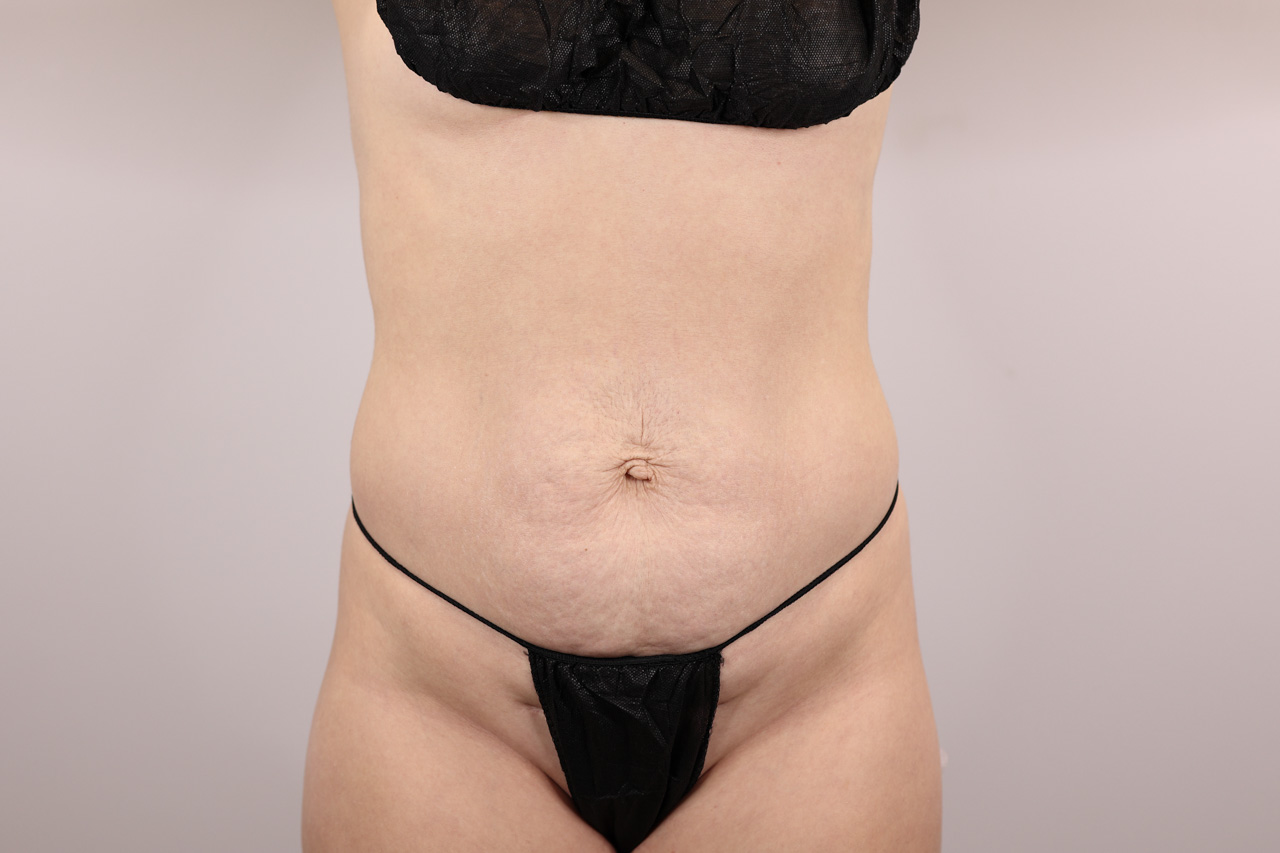 Abdomen & Waist/Flank Liposuction (Lipo 360)