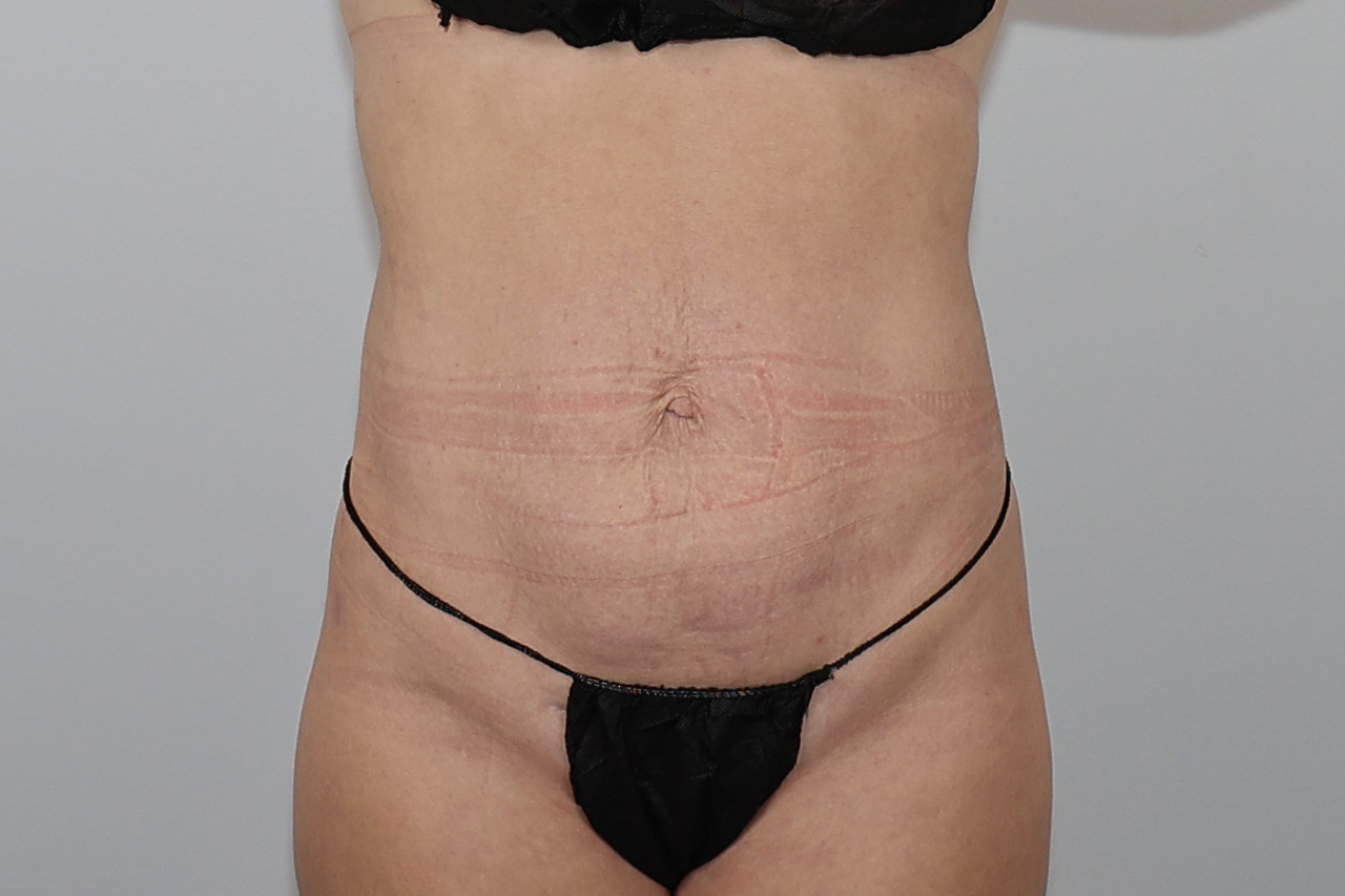 Abdomen & Waist/Flank Liposuction (Lipo 360)