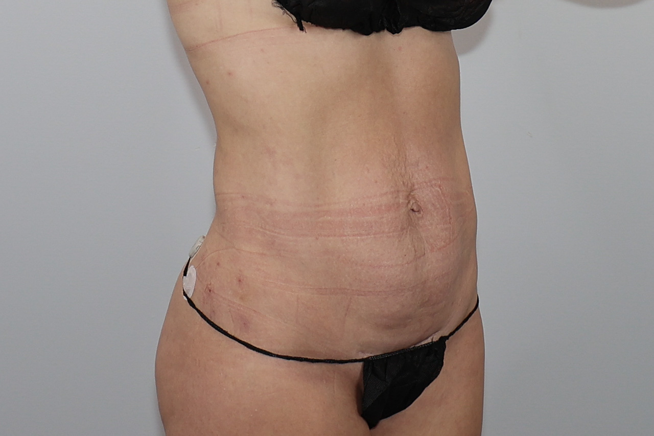 Abdomen & Waist/Flank Liposuction (Lipo 360)