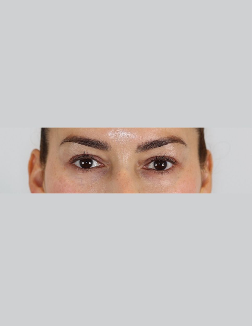 Eyelid Surgery (Upper Blepharoplasty)