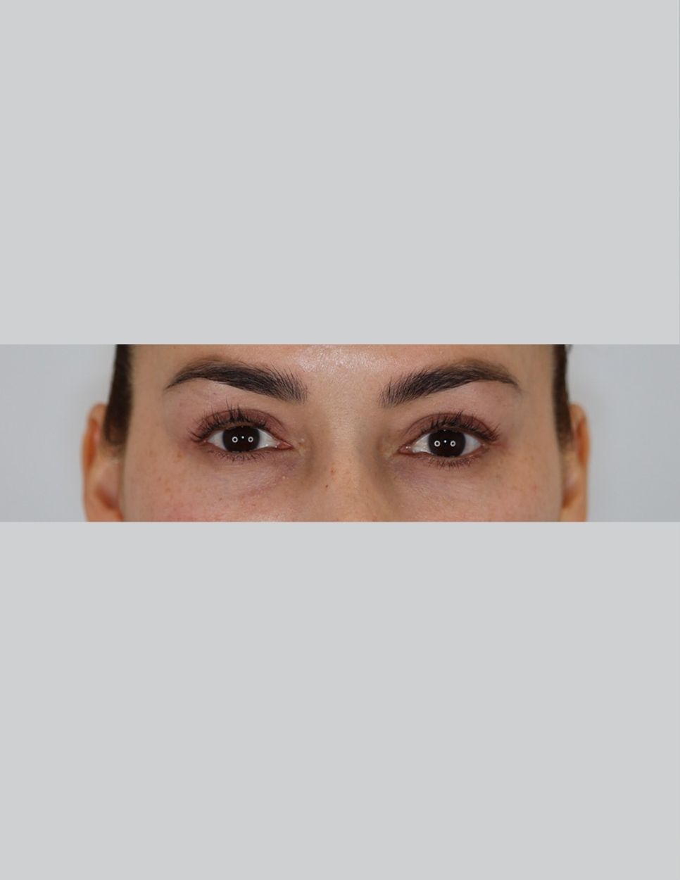 Eyelid Surgery (Upper Blepharoplasty)