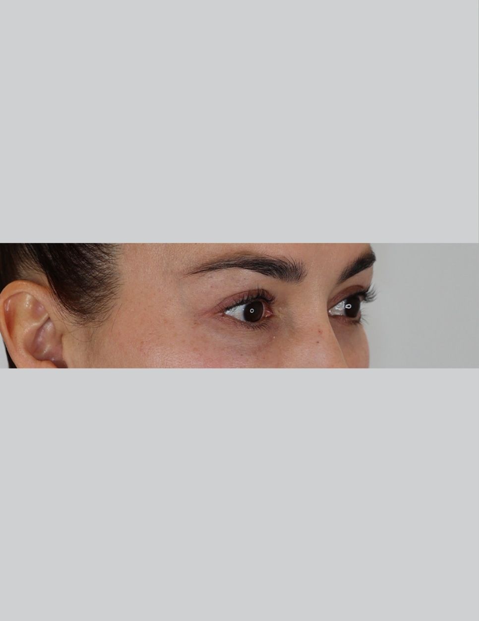 Eyelid Surgery (Upper Blepharoplasty)