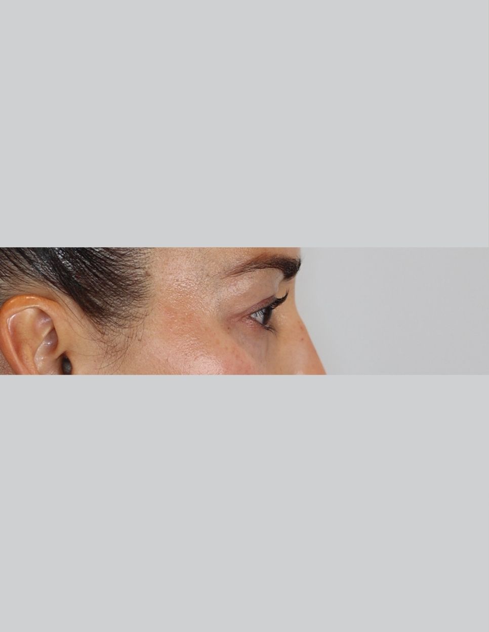 Eyelid Surgery (Upper Blepharoplasty)