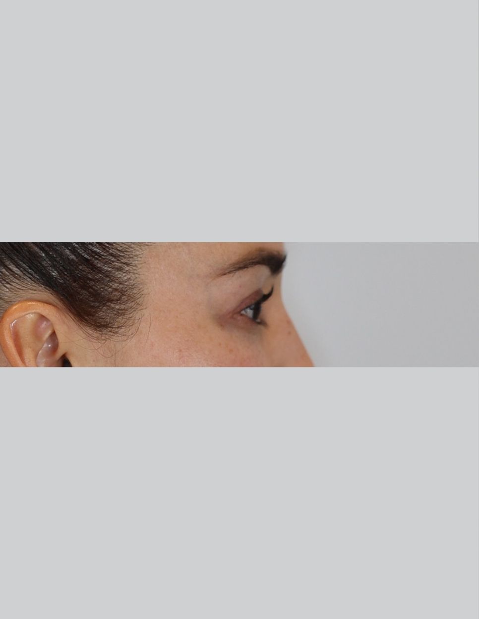 Eyelid Surgery (Upper Blepharoplasty)