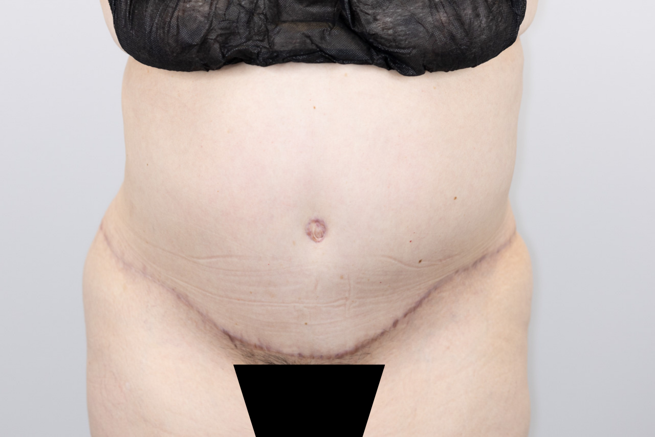 Tummy Tuck